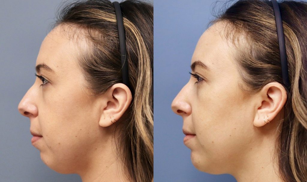 Weak Chin Med Spa Washington DC
