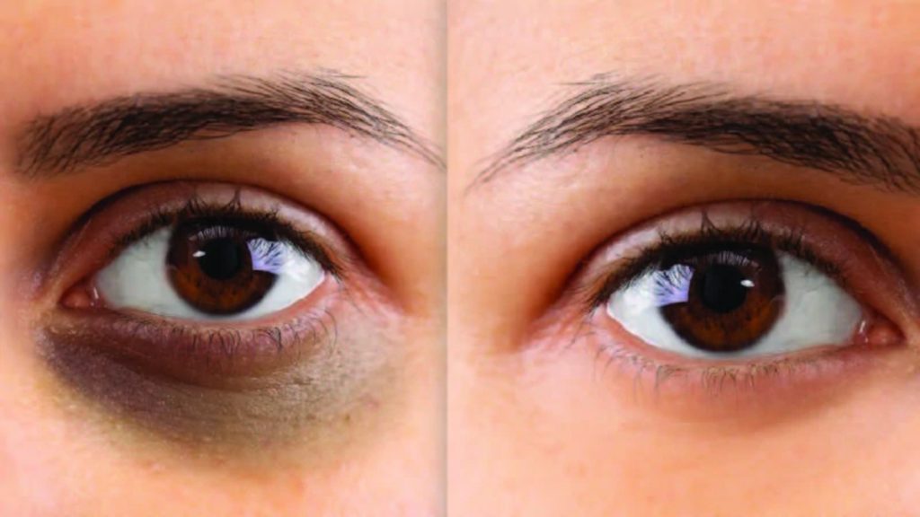 Dark Circle Eye Treatment Med Spa Washington DC