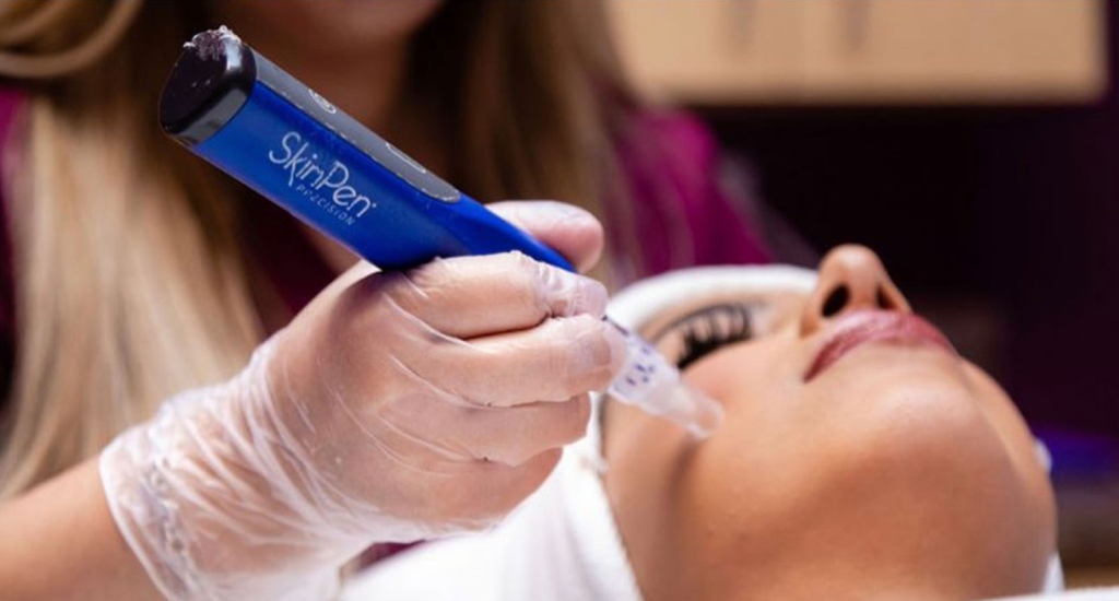 Skinpen Treatment