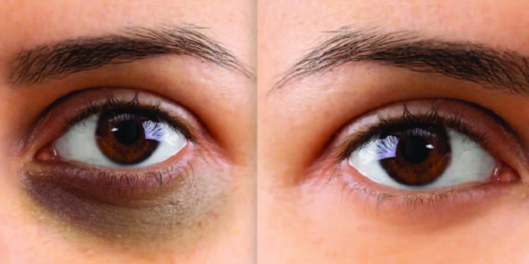 Dark Circle Eye Treatment Med Spa Washington DC