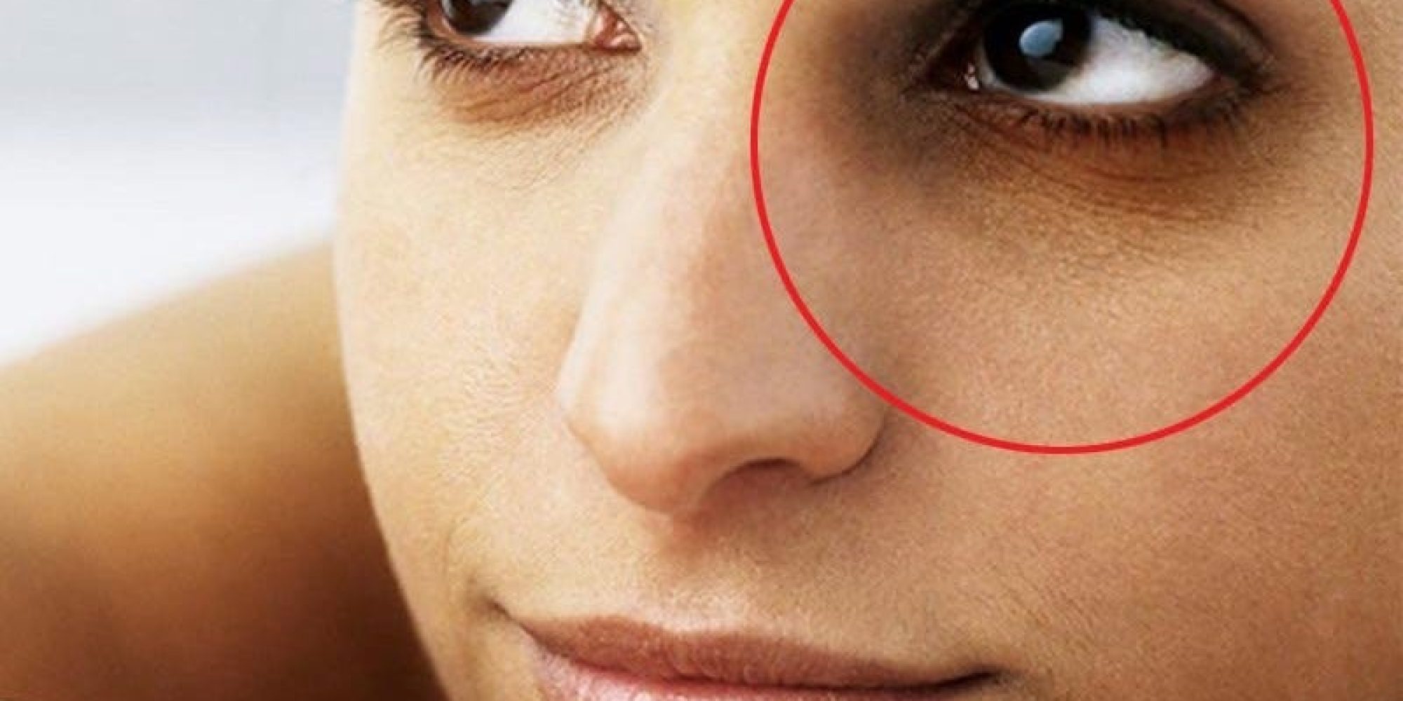 Dark Circles Under Eyes Med Spa Washington DC