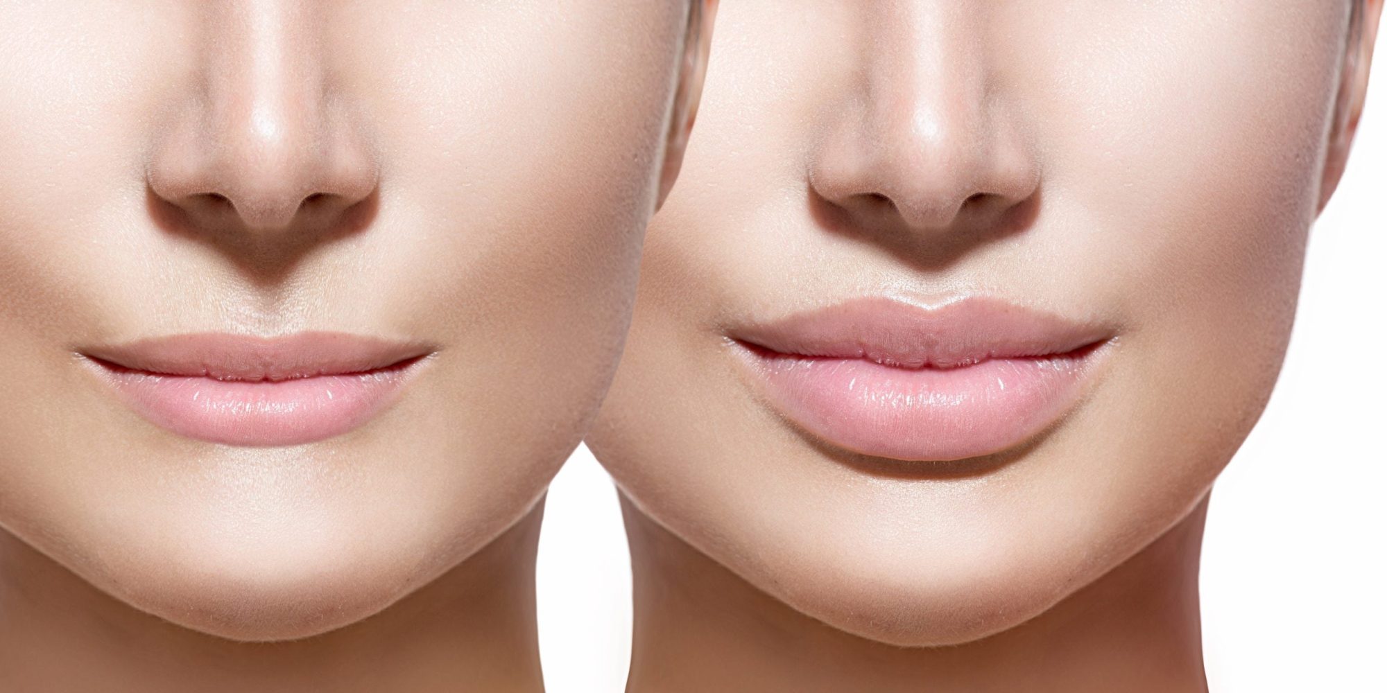 Lip Filler Washington DC Med Spa