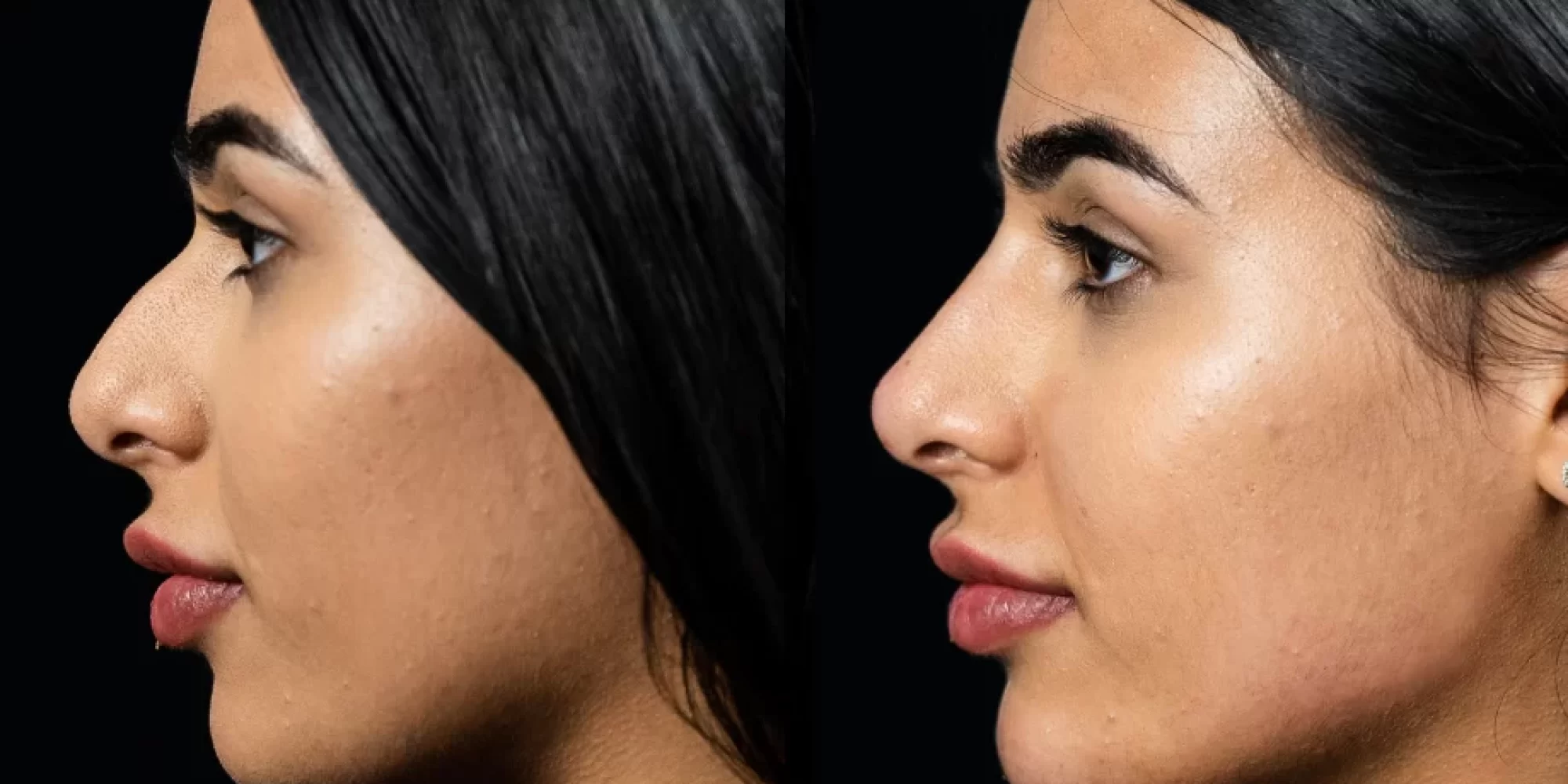 Liquid Rhinoplasty Med Spa Washington DC