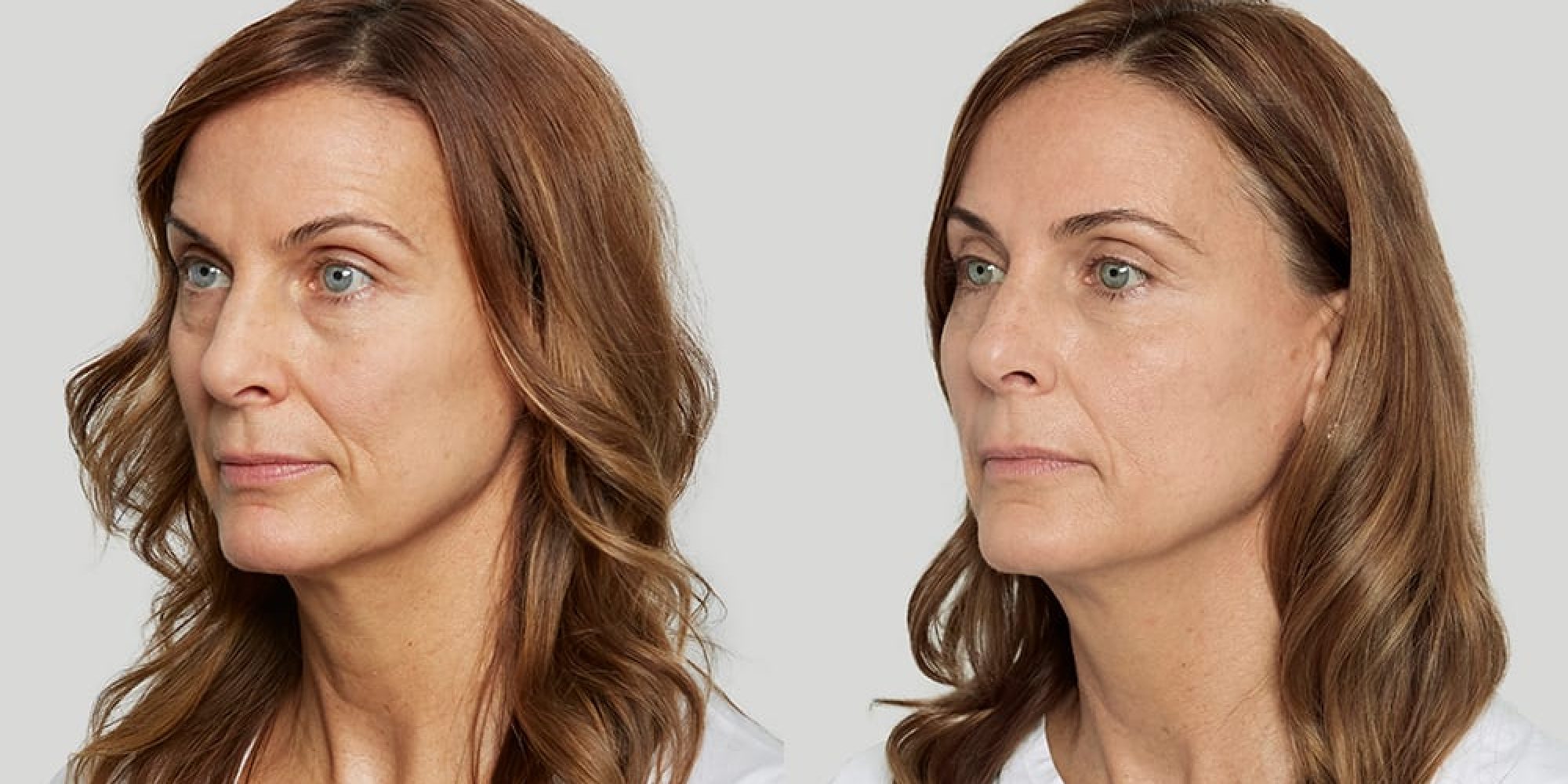 Sculptra Provider Med Spa Washington DC