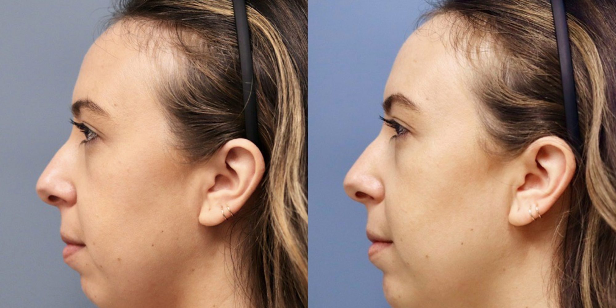 Weak Chin Med Spa Washington DC